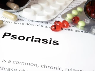 psoriasis treatment