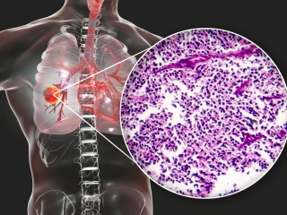 Malobuněčný karcinom plic