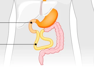 Short bowel syndrome