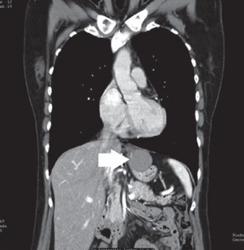 CT zobrazení tumoru, označeno šipkou.
Fig. 2. CT imaging of a tumour, marked with an arrow.