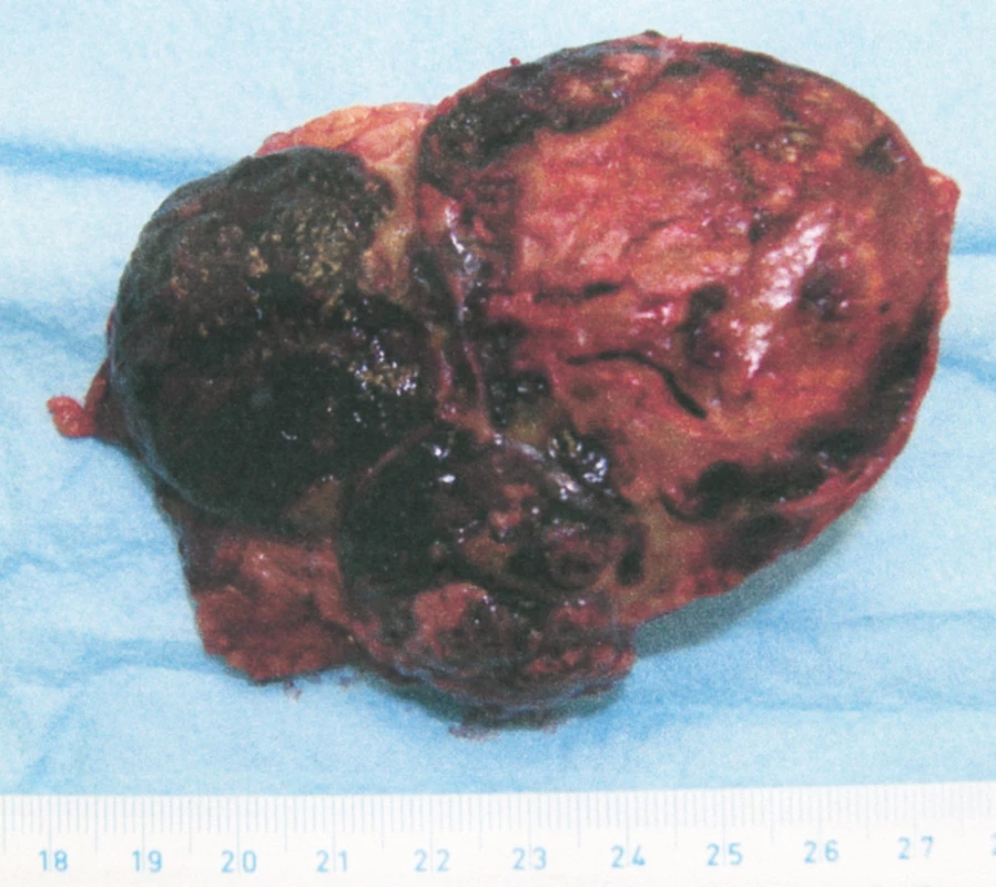Řez preparátem, histologicky karcinom kůry nadledviny (CT viz obr. 3)
Fig. 6. Histological section through the specimen, carcinoma of the adrenal cortex (CT – see Fig. 3)
