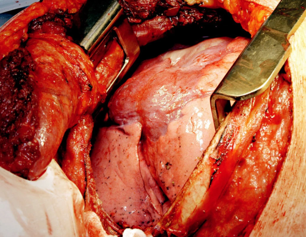 Peroperační nález rozsáhlého tumoru prorůstající do středního laloku pravé plíce
Fig. 3. The peroperative view of the tumor growing into the middle lobe of the right lung