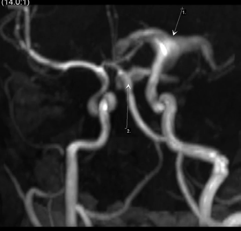 MRI AG 1 – původní aneurysma, 2 – nový vak na proximálním úseku AB s přestupem na ACP oboustranně (více vlevo).