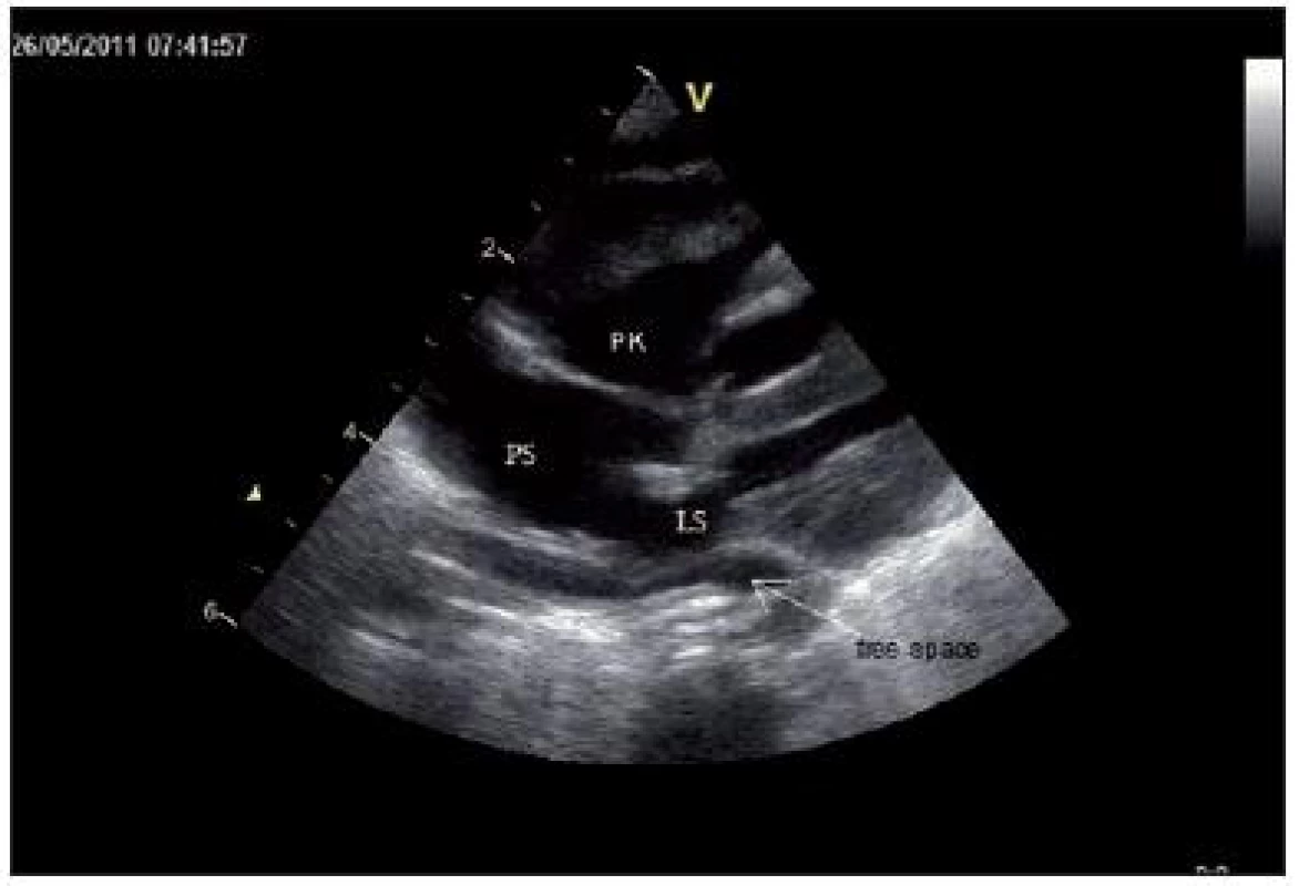 Subkostální koronární projekce: zvětšená pravá síň (PS) a pravá komora (PK), široká komunikace na síňovém septu. Za malou levou síní (LS) zachycen „free space“, který je vytvořen soutokem plicních žil. Dopplerovsky nelze prokázat komunikaci mezi LS a plicními žilami.
Fig. 4. Subcostal coronary view: enlarged right heart atrium and right ventricle, wide communication on the atrium septum. There is a „free space“ behind the left heart atrium, which is formed by confluence of pulmonary veins, without any connection to left heart.