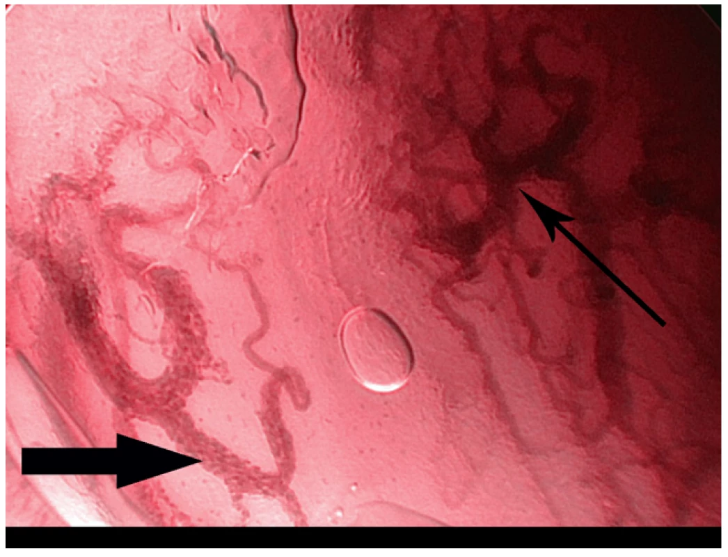 Kontaktní NBI endoskopie – spinocelulární karcinom hlasivky. Uvnitř rozšířených kapilár jsou patrné jednotlivé erytrocyty (široká šipka), typické změny vaskularizace svědčící pro malignitu (úzká šipka).