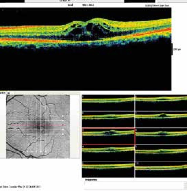 Optická koherenční tomografie cystického makulárního edému