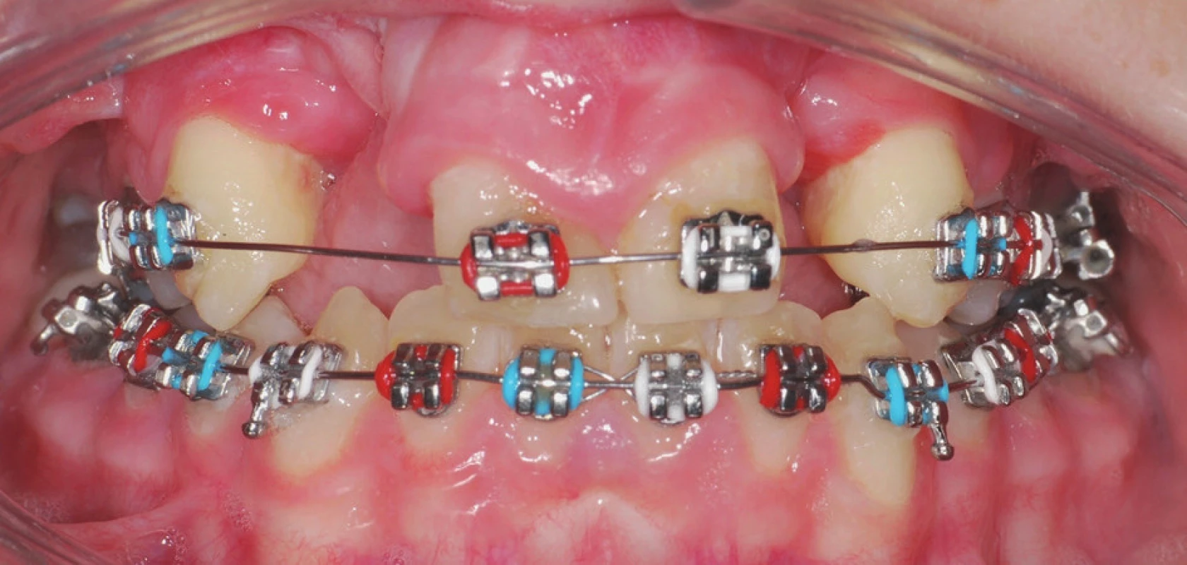 Pacientka s oboustranným celkovým rozštěpem a chybějícími zuby 12 a 22 s nasazeným fixním aparátem na horní a dolní čelisti. Ortodontickou léčbou bylo dosaženo správného postavení jednotlivých zubů horní čelisti a vyhovujícího vztahu zubních oblouků. Pacientka je připravována na protetickou rehabilitaci chrupu fixním můstkem.