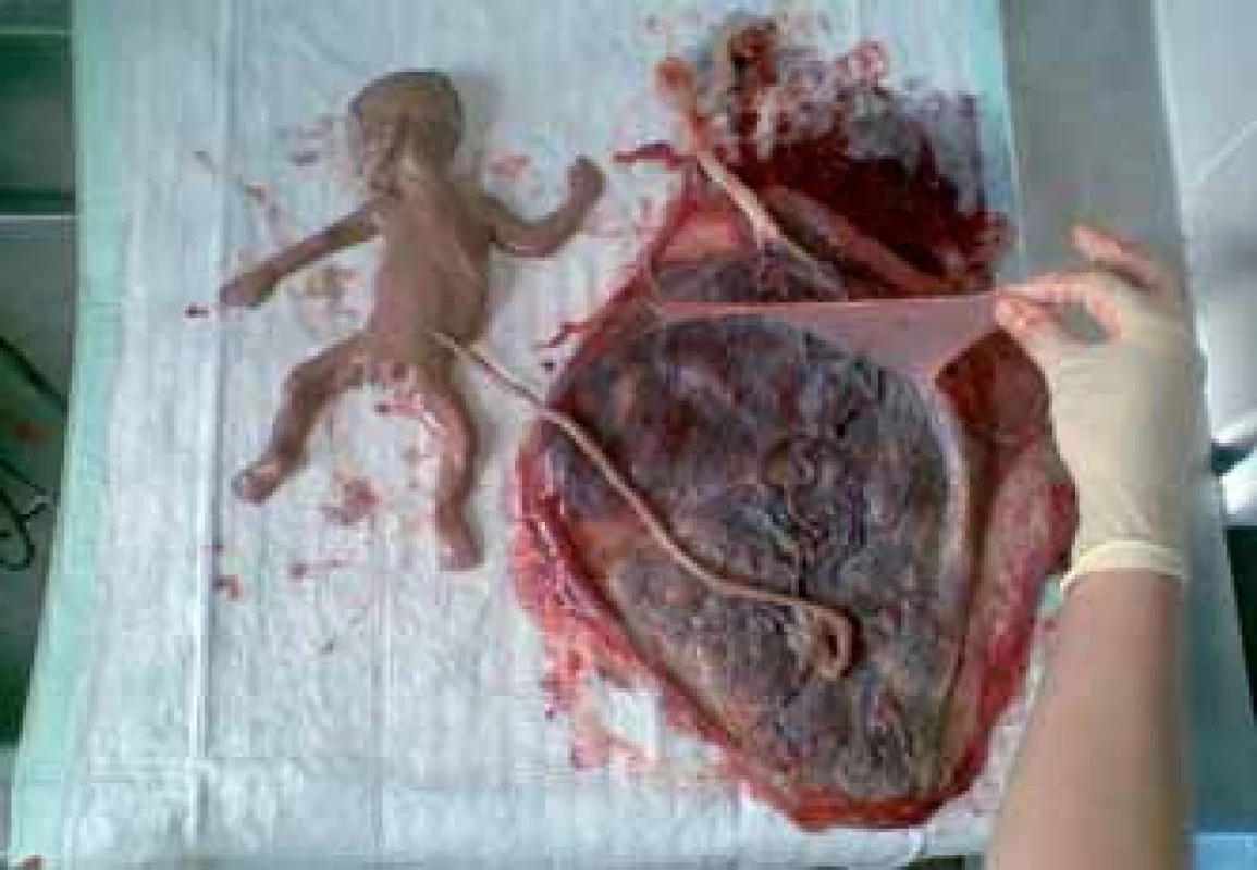 Monochoriální biamniální gravidita – porozen jeden zdravý plod, na obrázku druhý plod po selektivní fetocidě zobrazena amniální přepážka.