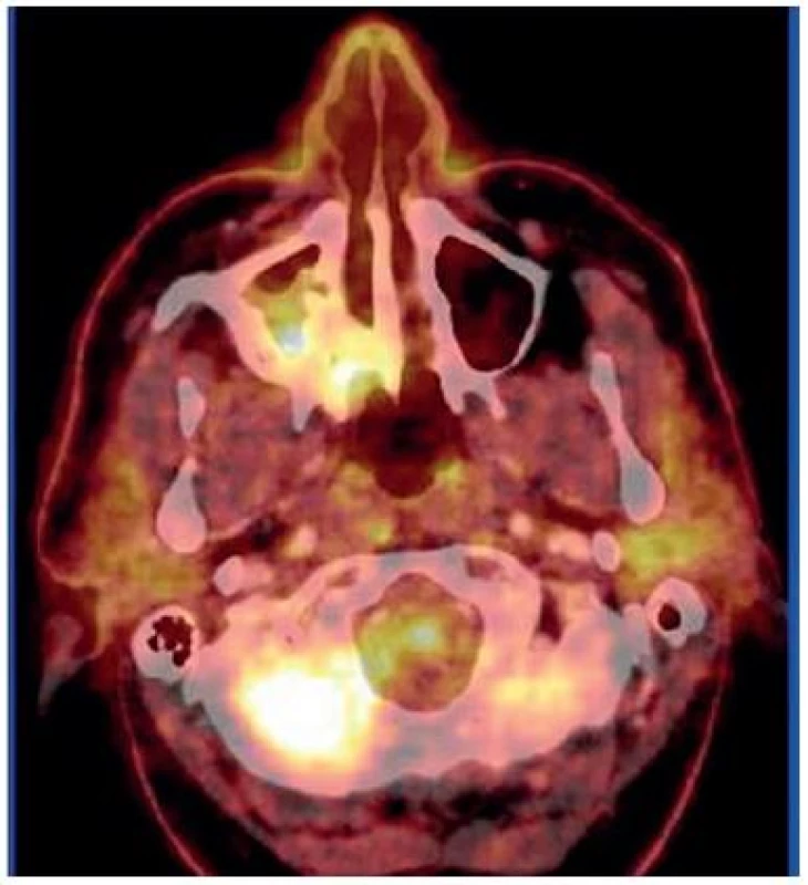 Axiální PET CT řez – sytící se tumor