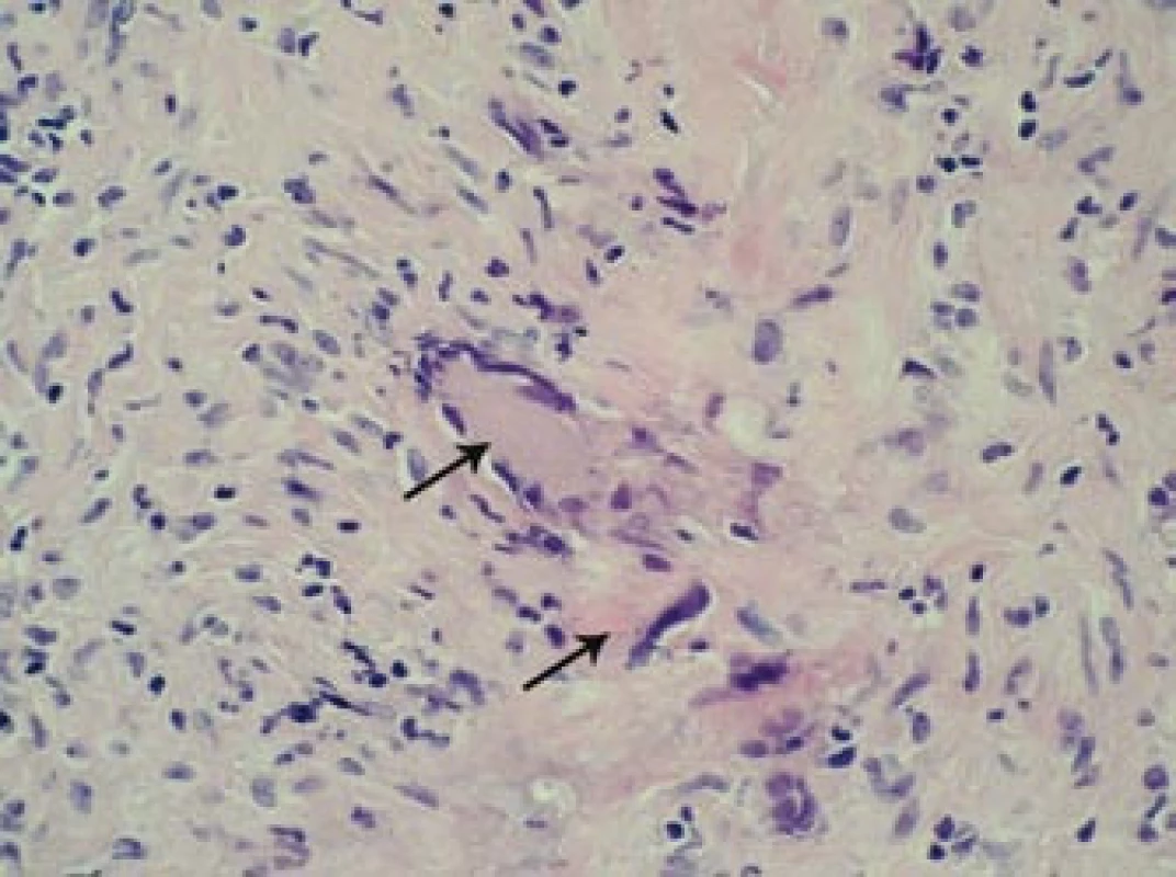 Histopatologický nález: šipky označují charakteristické obrovské mnohojaderné buňky infiltrující oblast tunica media stěny pravostranné větve temporální arterie. Barvení HE, 400krát.