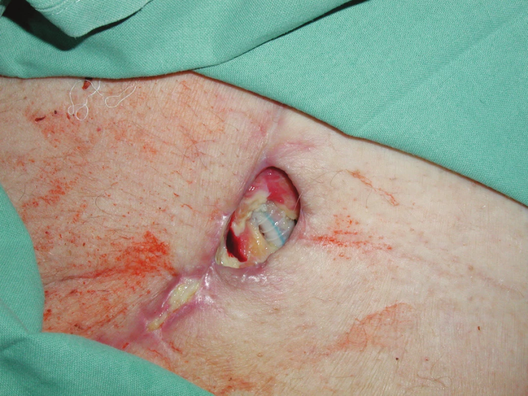 Dehiscence rány v levém třísle s nekrózami a obnaženou PTFE protézou
Fig. 1. A wound dehiscence in the left groin with necroses and an exposed PTFE prosthesis