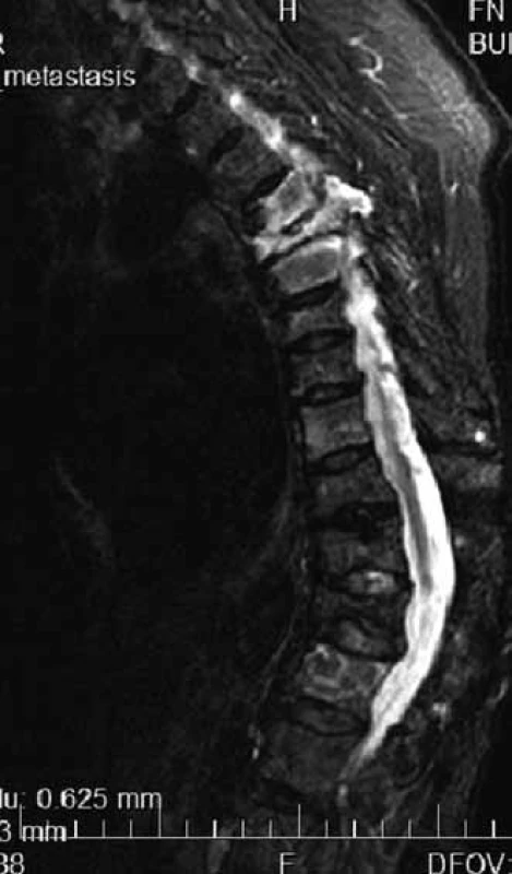 Multiple compressive fractures of thoracic vertebras in MR image, hypersingal-light – in the case of myeloma infiltration, dark in the case of osteoporosis.