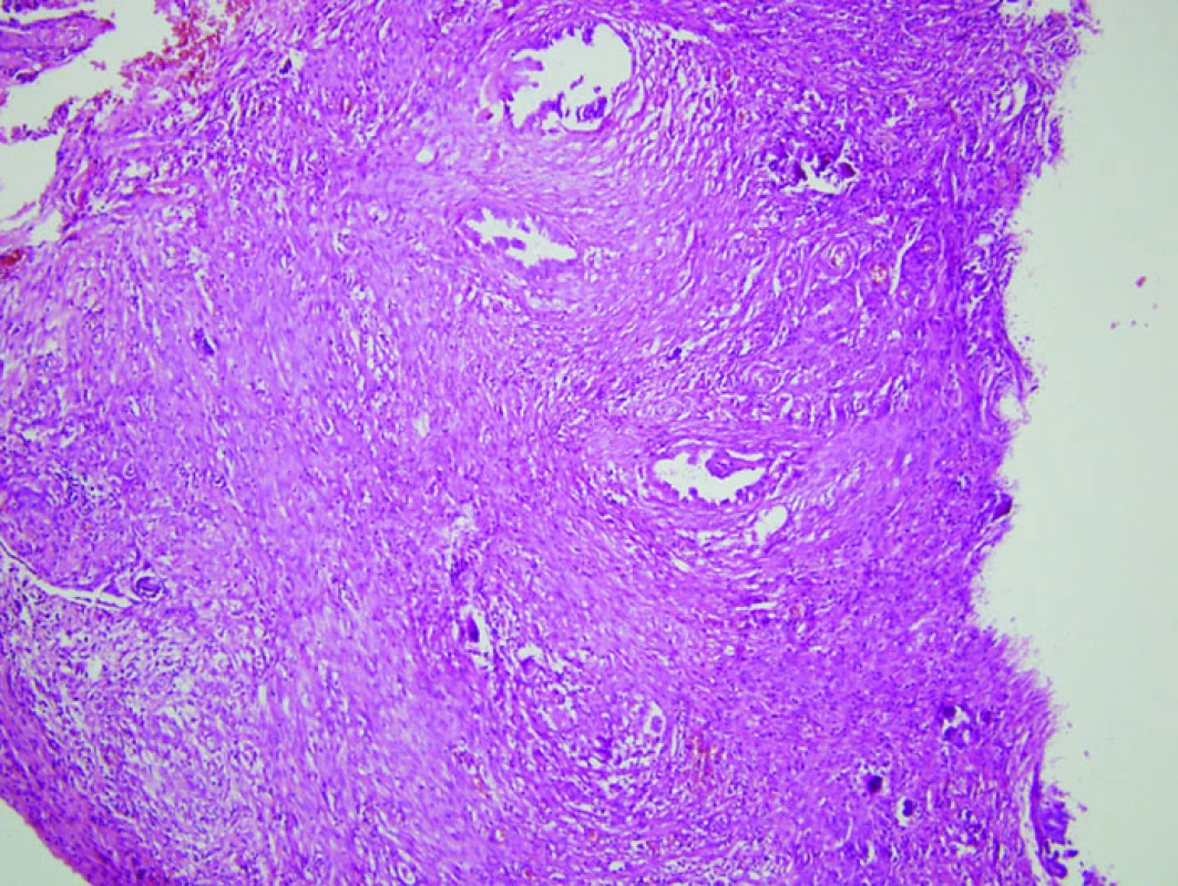 Histologický obraz mikroinvazivního serózního ovariálního borderline tumoru v 18. týdnu gravidity (HE, 4×).