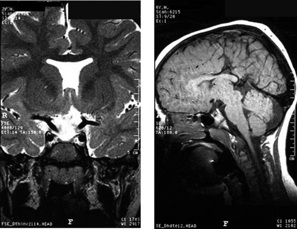 a, b. Typické MRI nálezy u pacientů se septooptickou dysplazií – ageneze septum pellucidum (a), hypoplazie corpus callosum (b).