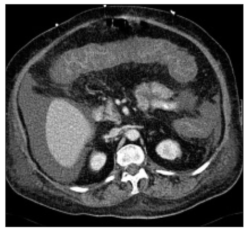 CT nález u těžké pseudomembranózní kolitidy. 