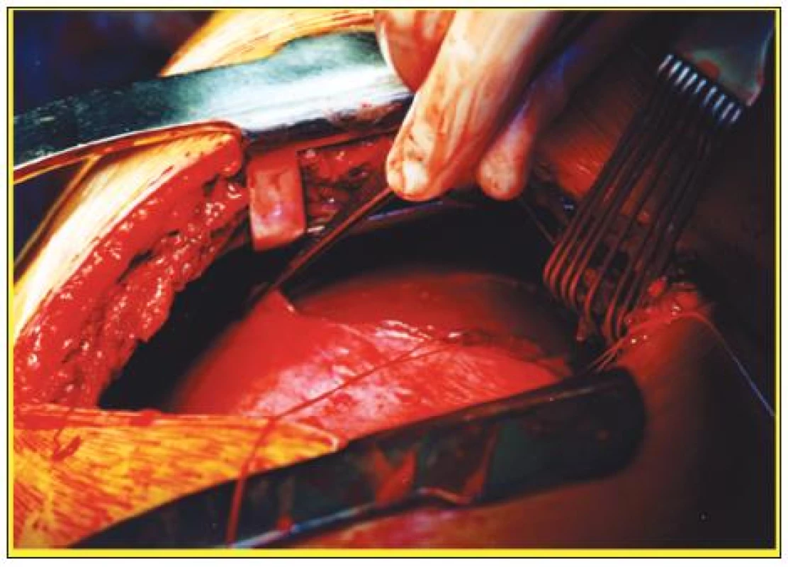 Peroperační snímek ruptury pravé poloviny bránice ošetřené suturou torakotomickou cestou
Fig. 3. Intraoperative view of the right-sided diaphragmatic rupture, managed by thoracotomy