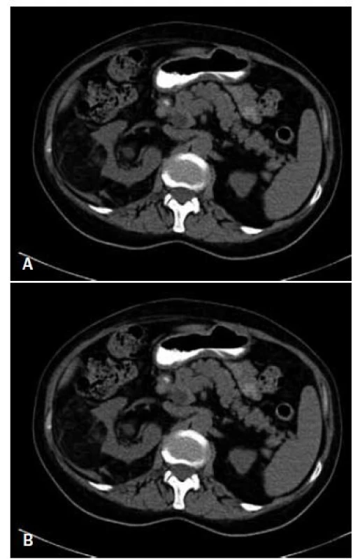 Třetí případ. Axiální CT břicha 74leté ženy demonstruje pravostranný renální angiomyolipom (AML) před aplikací kontrastní látky (A) a po aplikaci kontrastní látky (B) o rozměrech 7,5 × 6,0 × 5,5 cm.