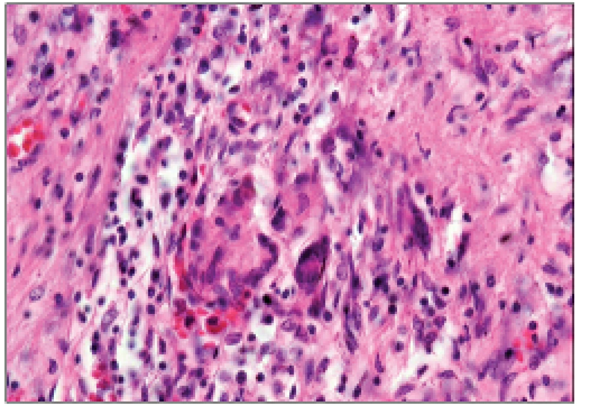 Obrovskobuněčná granulomatózní arteritis a. pulmonalis (barvení HE; původní zvětšení 400krát).