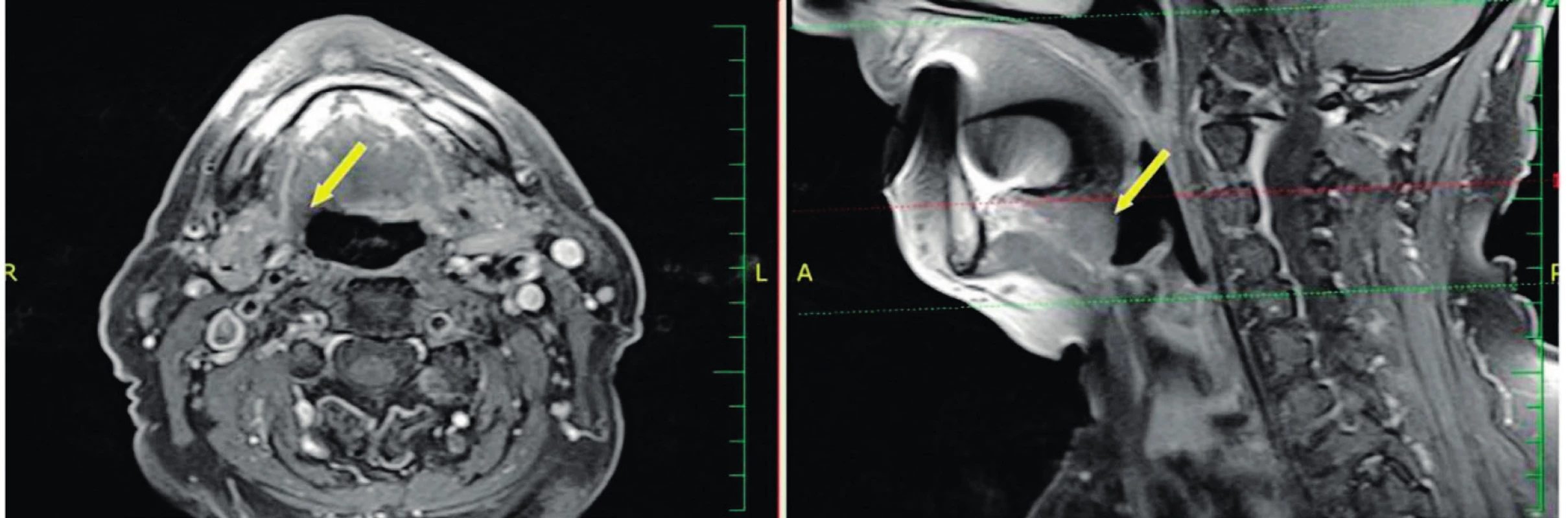 Oba snímky MR T1 s potlačením signálu tuku postkontrastně - šipka ukazuje na oblast kořene jazyka 1 rok po TORS.