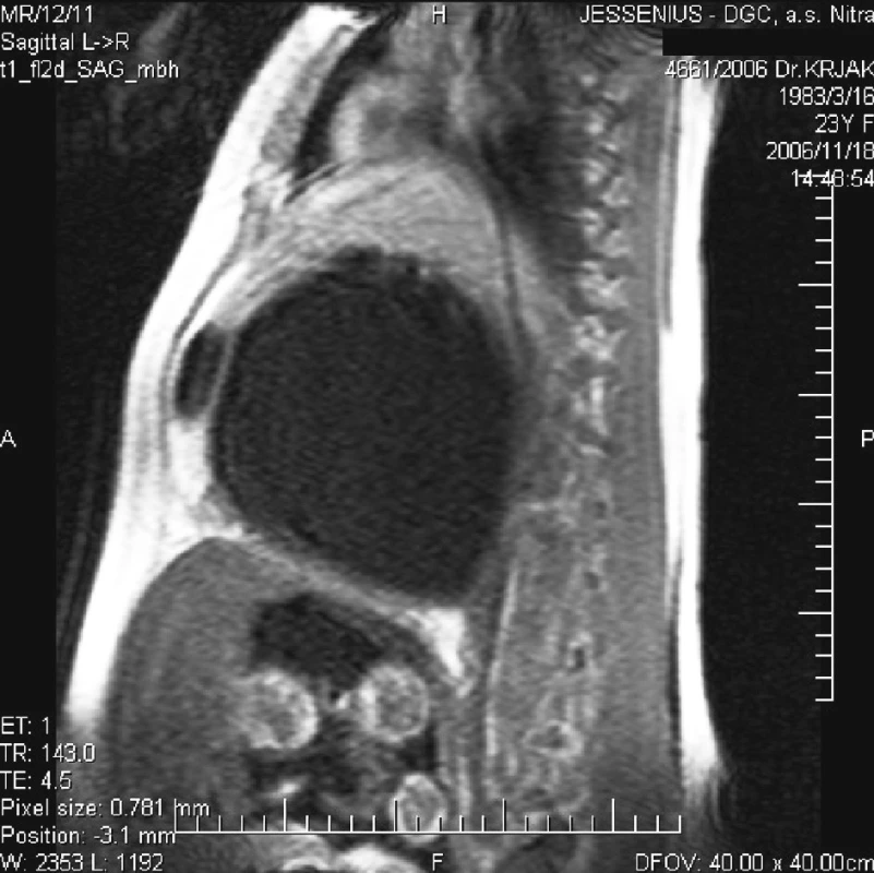 MR nález dutiny brušnej znázorňujúce cystu a plod
Pic. 3. MR intraabdominal finding depicting a cyst and a foetus