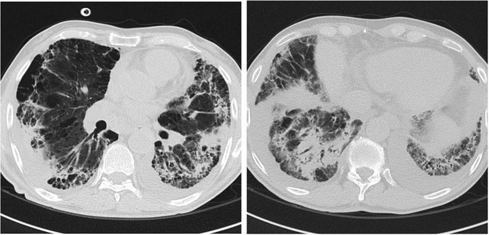 Chest CT scan image after 14 days of broad-spectrum therapy with deteriorating respiratory condition: increase in size and number of the parenchymal consolidation and ground-glass areas, consistent with ongoing pneumonia