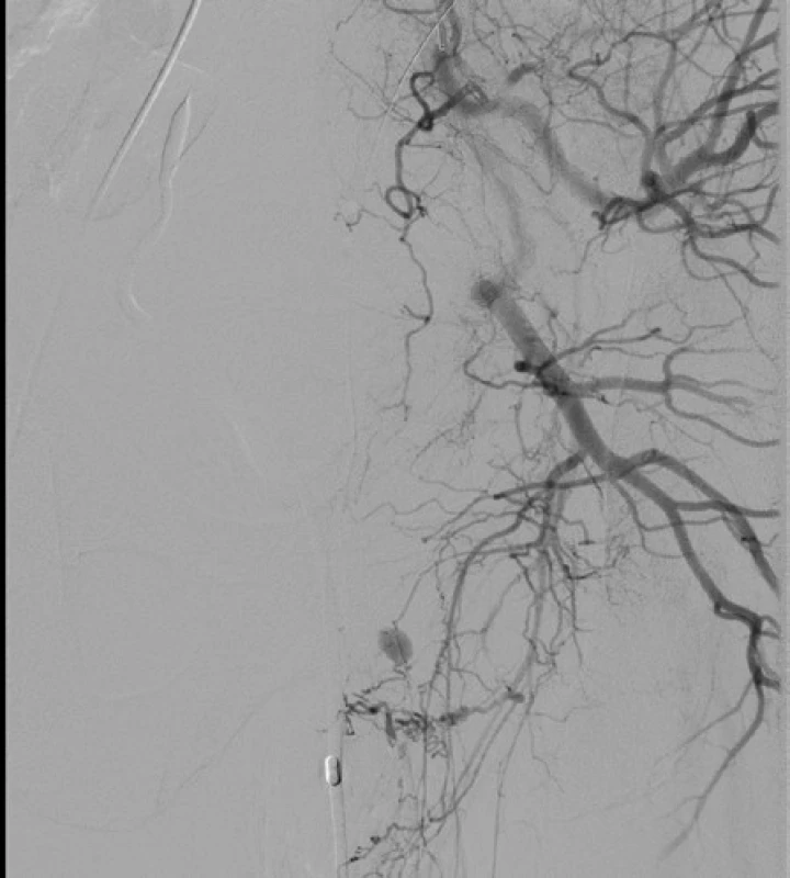 &lt;i&gt;Angiografie – leak z a. iliaca interna l. sin&lt;/i&gt;
Fig. 4. &lt;i&gt;Angiography – leak from left internal iliac artery&lt;/i&gt;