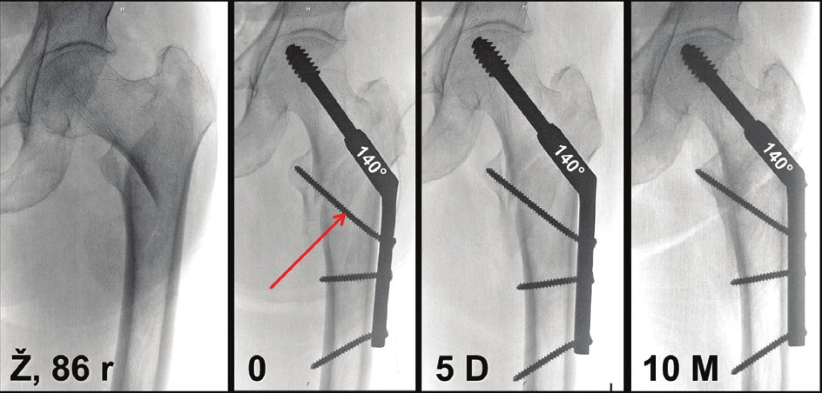 Nestabilní pertrochanterická zlomenina dokonale ošetřená DHS: a – nestabilní pertrochanterická zlomenina u 86leté pacientky; b – pooperační snímek, provedena valgózní repozice a osteosyntéza 140° DHS, úhel repozice odpovídá úhlu implantátu, skluzný šroub prochází středem proximálního úlomku, špička šroubu je těsně subchondrálně, proximální kortikální šroub prochází špičkou mediální kortikalis krčku femuru a brání tak jejímu sklouznutí do dřeňového kanálu; c – rtg snímek 5 dní po operaci, není patrná komprese úlomků; d – za 10 měsíců po operaci je zlomenina zhojena, komprese úlomků je minimální, jak je patrné na vztahu obou mediálních kortikalis. 
Fig. 19: Unstable pertrochanteric fracture flawlessly treated with DHS: a – an unstable pertrochanteric fracture in a 86-year old female patient; b – postoperative radiograph; valgus reduction and internal fixation with a 140° DHS, the reduction angle corresponds to the implant angle, the lag screw passes through the centre of the proximal fragment, the screw tip is close to the subchondral bone, the tip of the proximal cortical screw passes through the medial cortex of the femoral neck and prevents thus its subsidence in the medullary canal; c – radiograph 5 days postoperatively with absence of compression of fragments; d –10 months postoperatively the fracture is healed, compression of fragments is minimal as shown by the relation of both medial cortices. 