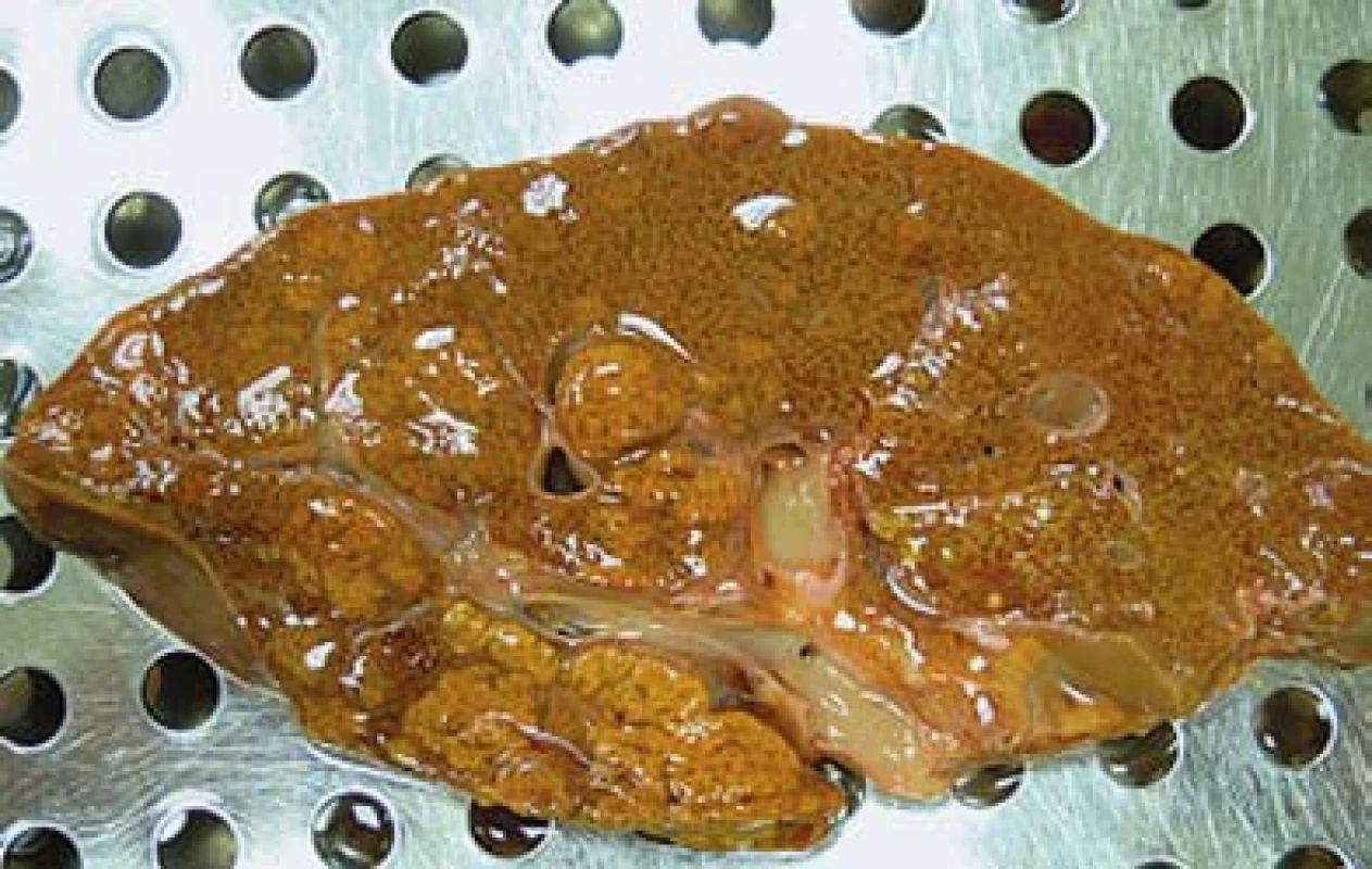 Multifokální hepatocelulární karcinom. Na řezu jsou patrny uzly žlutohnědé barvy místy splývající.
Fig. 2. Multifocal hepatocellular carcinoma. In the section there are visible nodes of yellow-brown colour, confluent at some places.