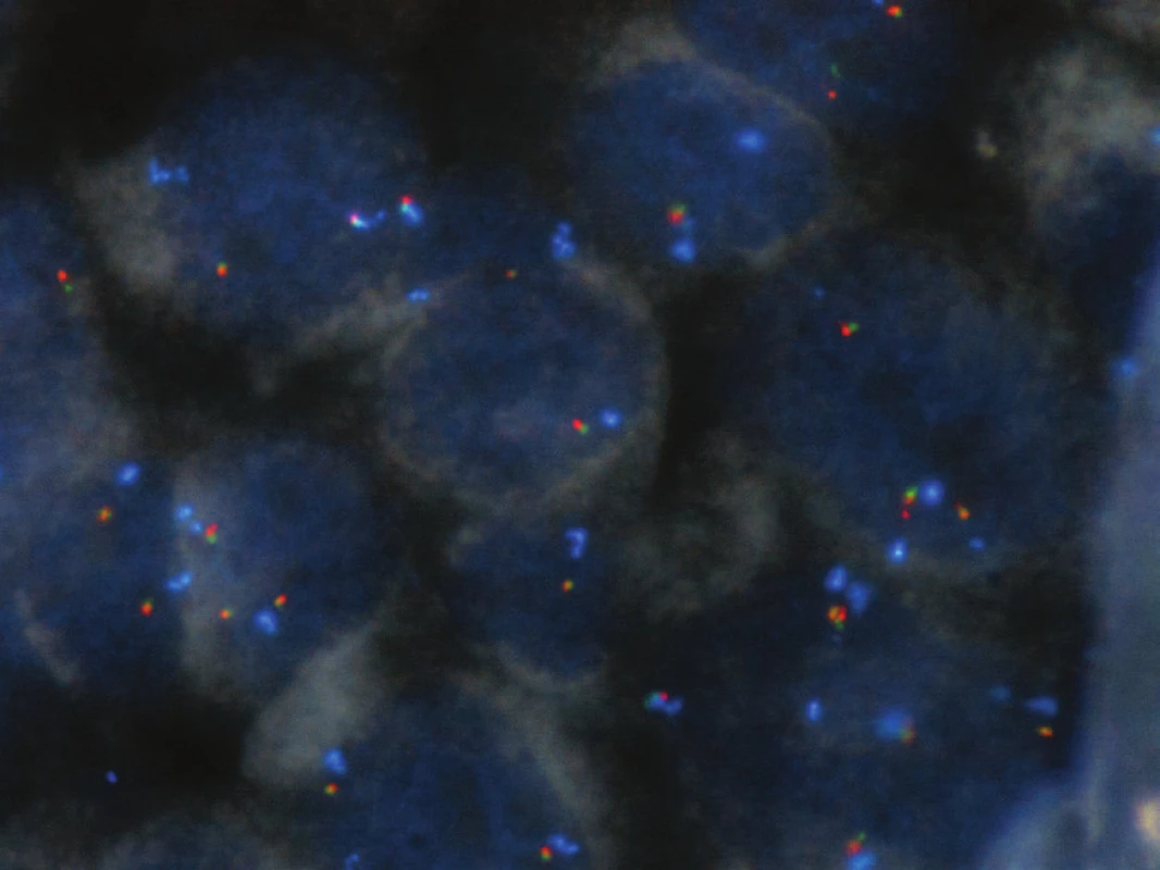 Nádorové buňky bez přestavby genu &lt;i&gt;ALK&lt;/i&gt; (červený a zelený signál v těsné blízkosti, absence nadpočetného modrého signálu), zvětšení 1000x.