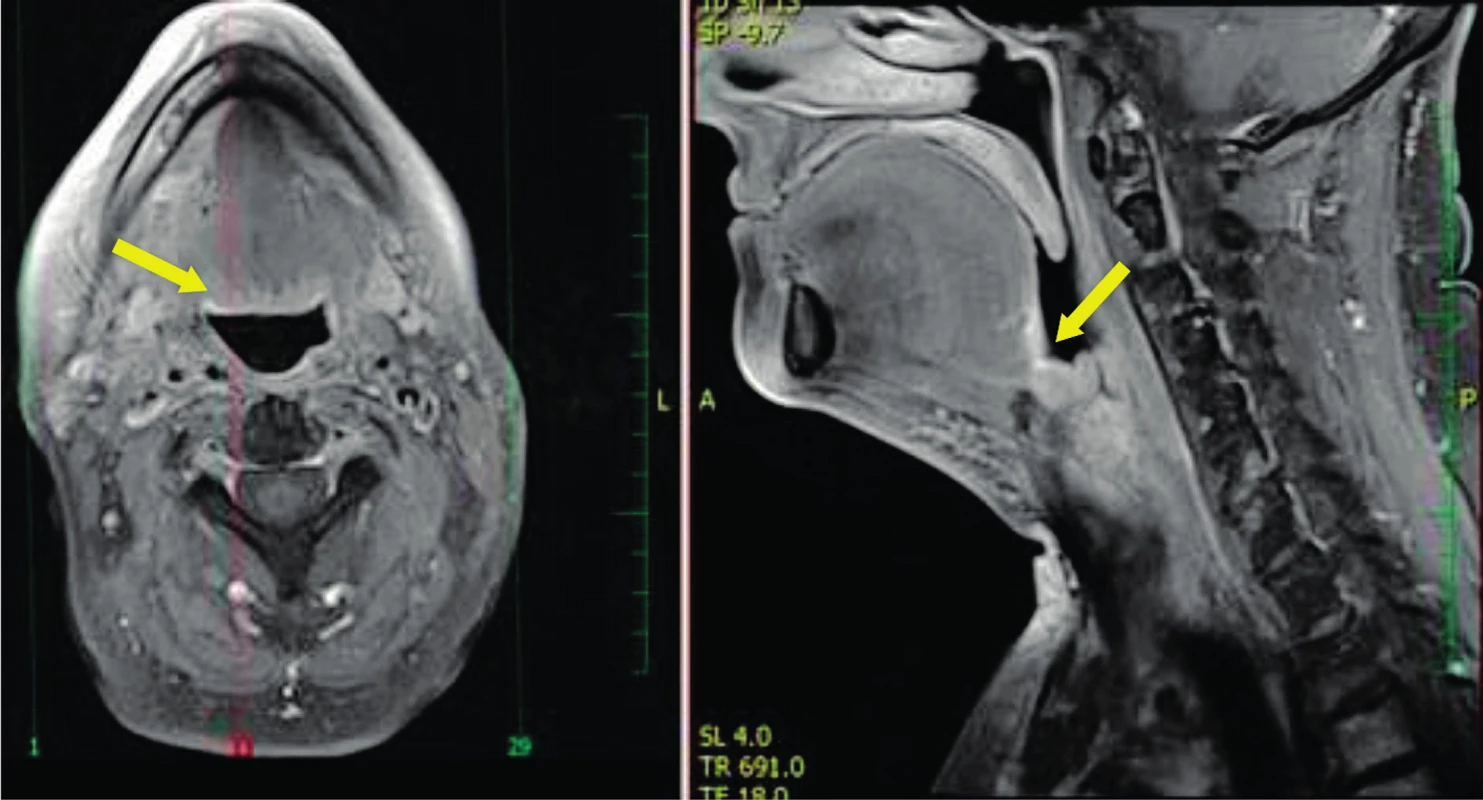 Oba snímky MR T1 s potlačením signálu tuku postkontrastně - šipka ukazuje na oblast lůžka po rozšířené tonzilektomii 1 rok po zákroku TORS.