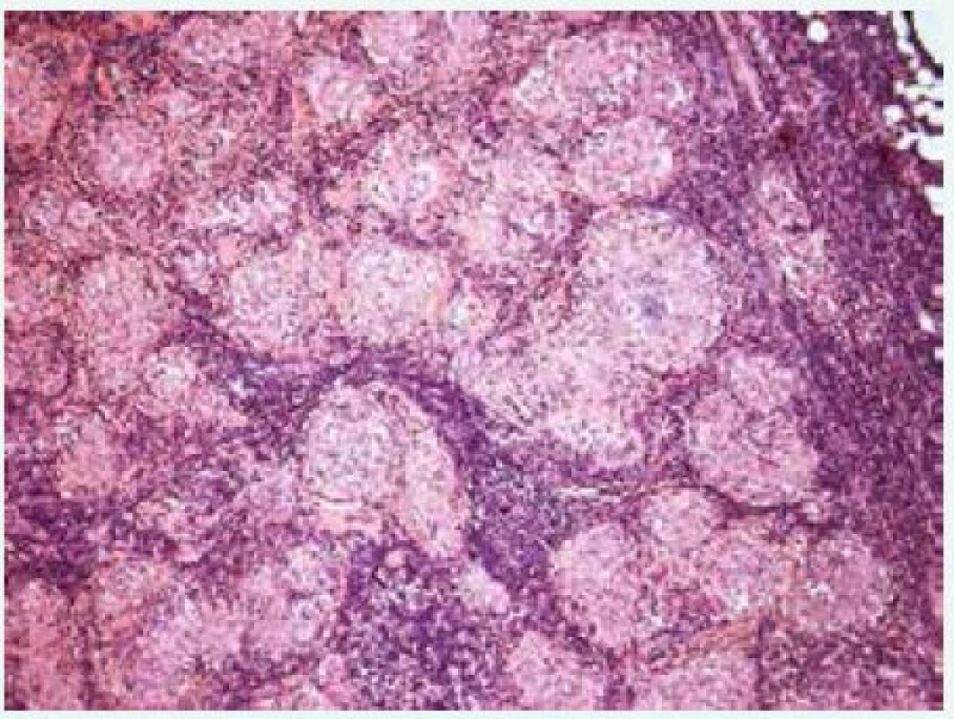 Histologický průkaz granulomů u pacienta se sarkoidózou. Granulomy při sarkoidóze mají charakteristický vzhled. Jsou menší, ostře ohraničené, poměrně uniformní, bez nekróz a jsou tvořené především epiteloidními histiocyty s nečetnými obrovskými mnohojadernými buňkami Langhansova typu. Obvykle jsou hojné a hustě nakupené (Histopatologický obrázek poskytl MUDr. Mojmír Moulis)