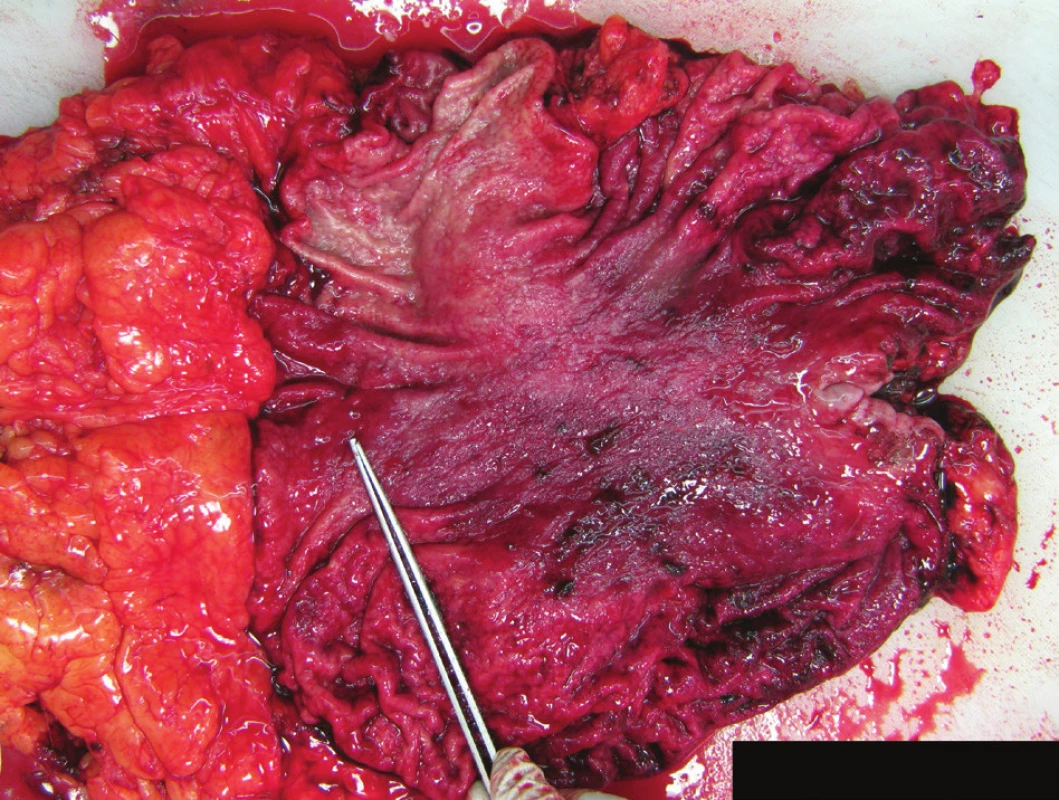Preparát žaludku s infiltrací adenoneuroendokrinním karcinomem
Fig. 1: Gastric specimen – infiltration with mixed adenoneuroendocrine carcinoma