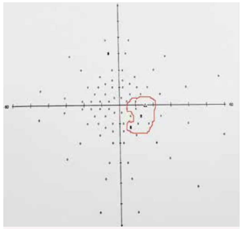 Vyšetření zorného pole pravého oka na perimetru Full field 81 zobrazující rozšířený Mariottův bod u pacienta s edémem terče zrakového nervu při idiopatické intrakraniální hypertenzi na pravém oku – rozšíření naznačeno červeným obrysem. Vpravo od centra zorného pole je trojúhelníková značka označující v zorném poli Mariottův bod (slepou skvrnu) na obrázku obklopený křížky (značícími relativní výpady na perimetru) a dvěma černými čtverečky (vyjadřujícími absolutní výpady v zorném poli). Tyto výpady typicky provázejí edém terče zrakového nervu. Kroužky značí fyziologicky viděné body (podněty) při vyšetření zorného pole.