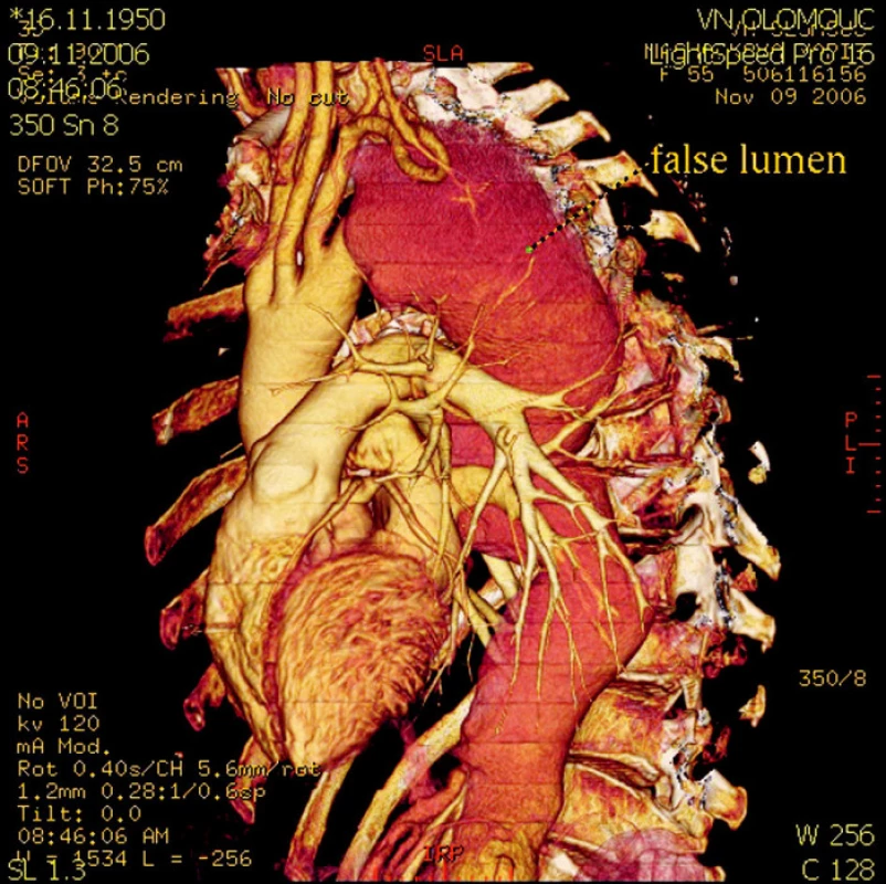 CT rekonstukce stavu před operací – rozsáhlé aneuryzma a disekce celého úseku hrudní a břišní aorty
Fig. 2. A CT reconstruction of the preoperative condition – extensive aneurysm and dissection of the whole thoracic and abdominal aortic region