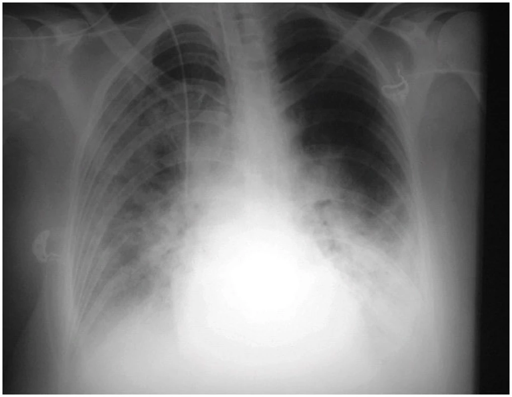 RTG snímek plic 56leté pacientky 1. den hospitalizace 
Nález popsán jako obraz oboustranného městnání v malém oběhu až charakteru kardiálního edému, při popisu kontrolního snímku po 2 dnech přehodnocen na oboustranné difuzní plicní infiltráty.