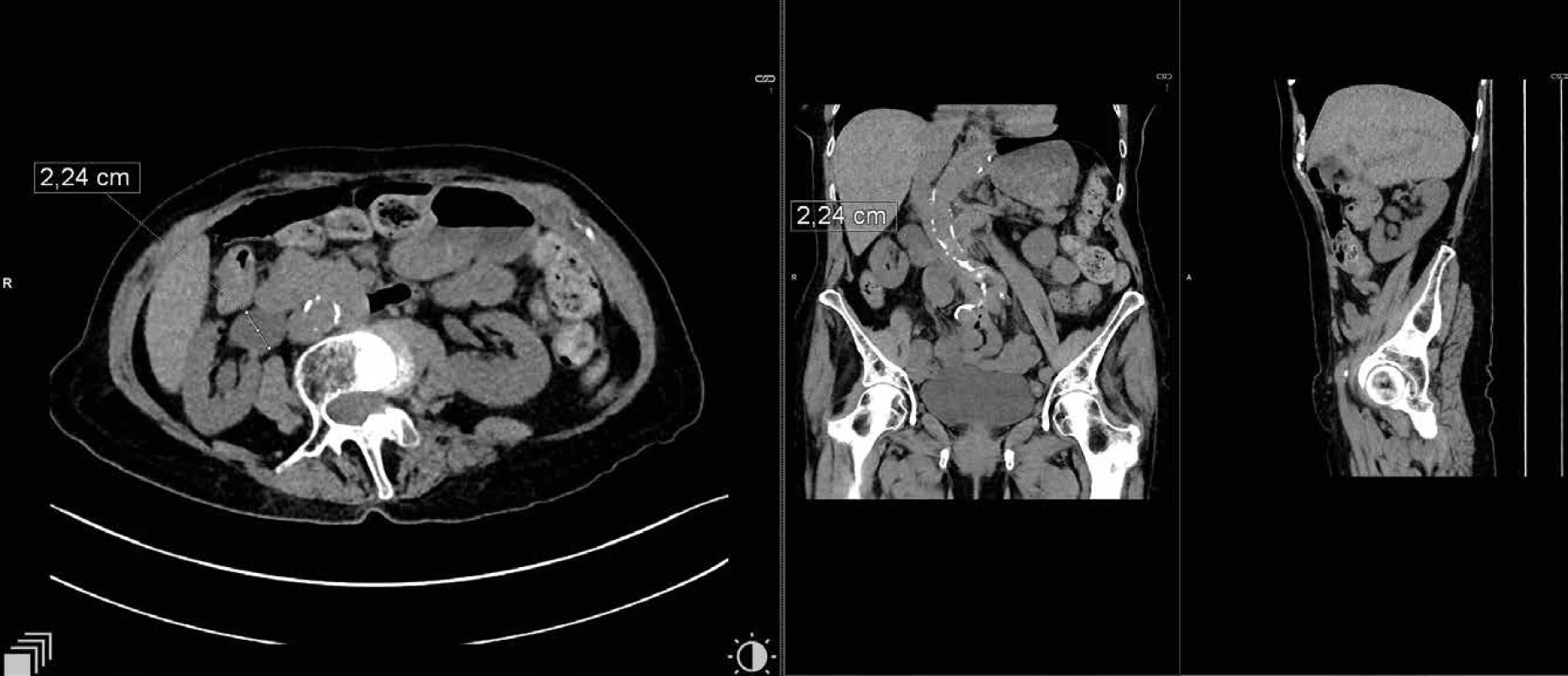 Dilatace ledvinné pánvičky pravé ledviny   Fig 2: Dilation of renal pelvis of the right kidney