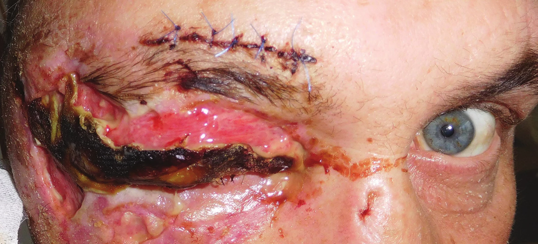 Pacient po úraze hlavy a tváre po primárnom ošetrení a suture v oblasti supercília s rozsiahlym defektom kože v oblasti mihalníc pravého oka
