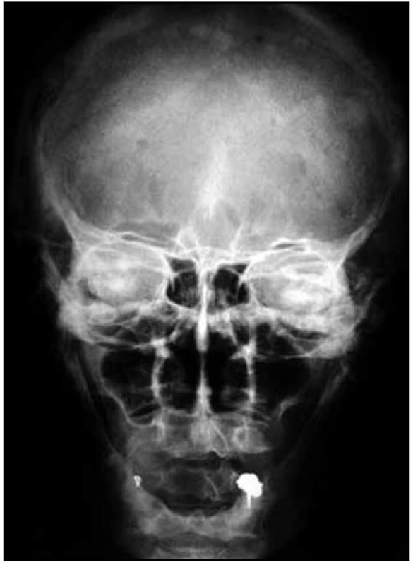 Předozadní RTG snímek lebky s osteosklerotickými ložisky u pacientky s osteosklerotickým myelomem a POEMS syndromem.