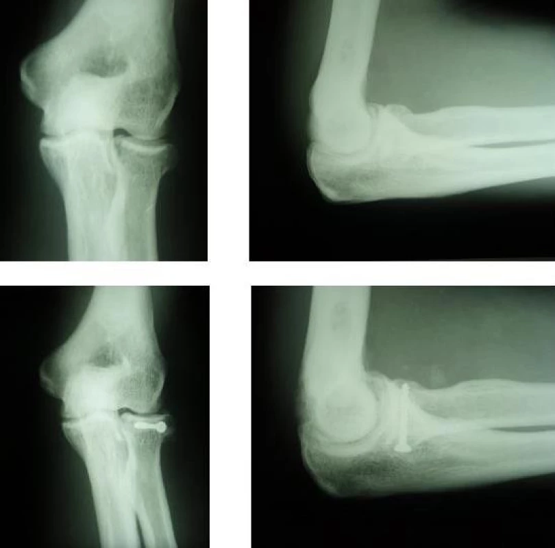 Použitie AO skrutky pri osteosyntéze hlavičky radia. A,B – RTG snímky zlomeniny hlavičky radia typu Mason II. C, D – RTG snímky po osteosyntéze pomocou AO skrutky, 8 rokov po operácii