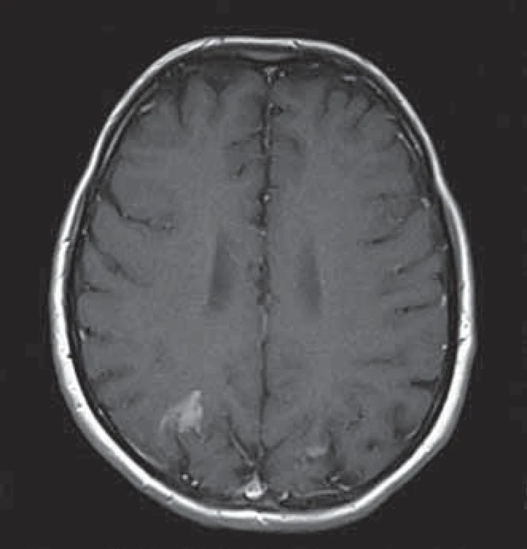 MRI nález: kortiko-subkortikálne lézie, T1 hyperintenzívne v gyrus occipitalis superior a cuneus bilat., výrazne vpravo, diskrétne v gyrus frontalis medius vľavo.