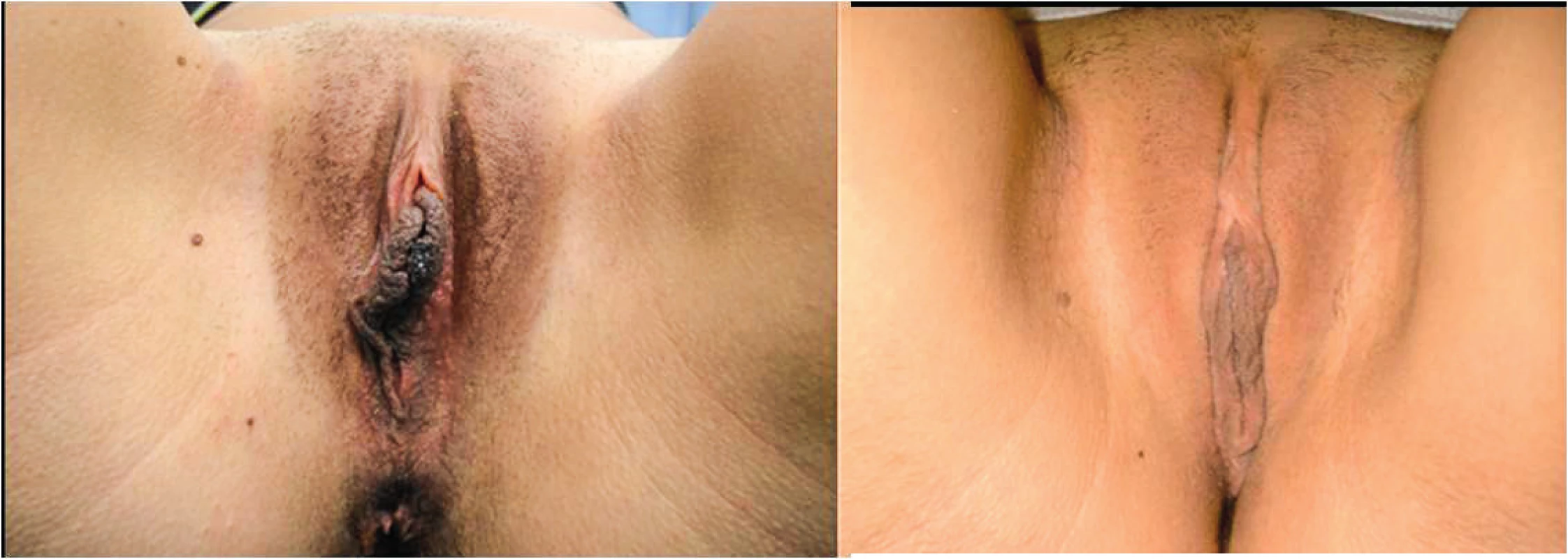 (Left) Pre-operative view in a 27 years old patient. (Right) Post-operative view at 1 year