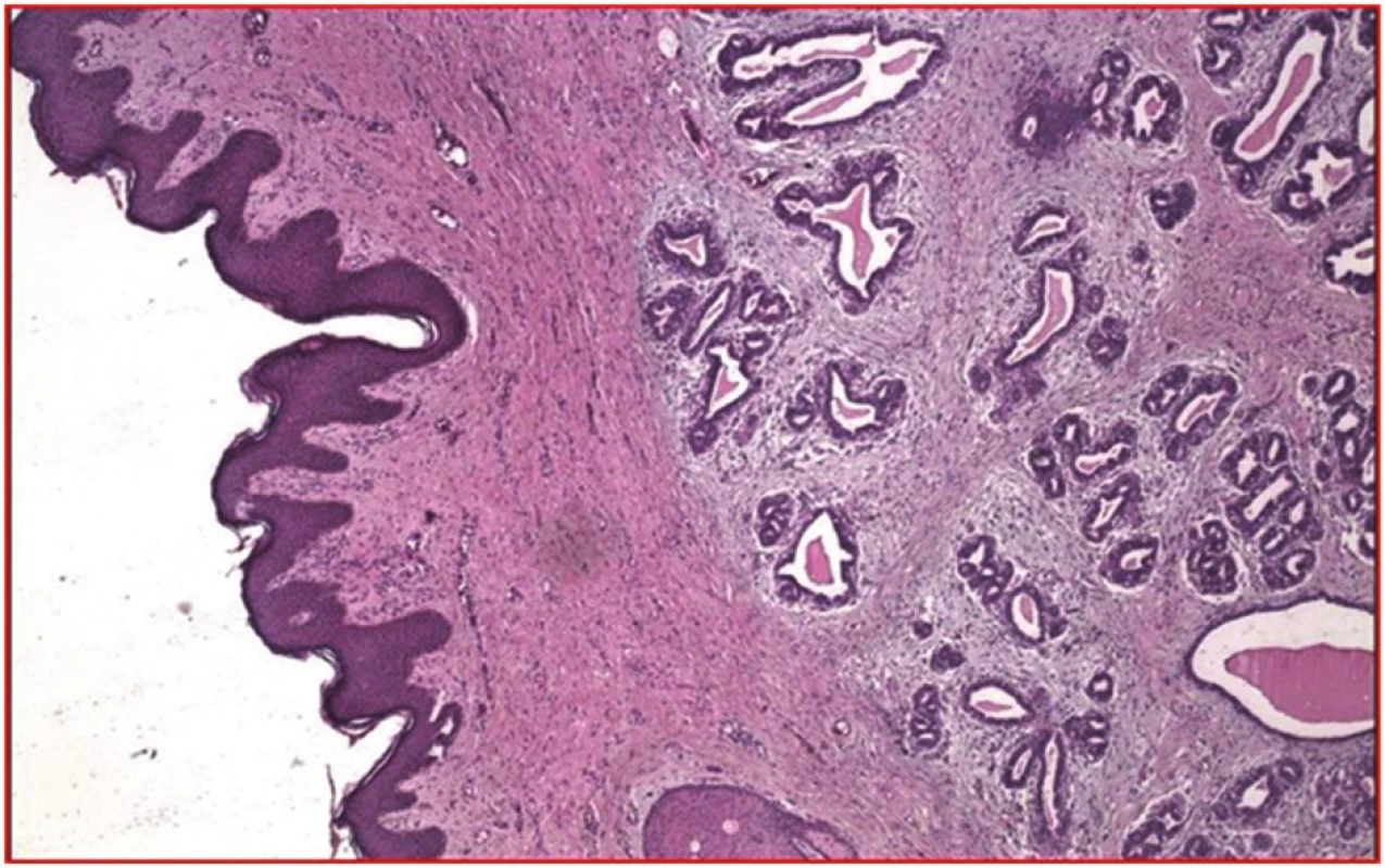 Dilatované vývody a atrofické lobuly heterotopickej mliečnej žľazy vo výrazne kolagenizovanej stróme (hematoxylín, eozín; 100x)
Fig. 6: Dilated ducts and atrophic lobules of heterotopic mammary gland in significantly collagenized stroma (hematoxylin, eosin; 100x)