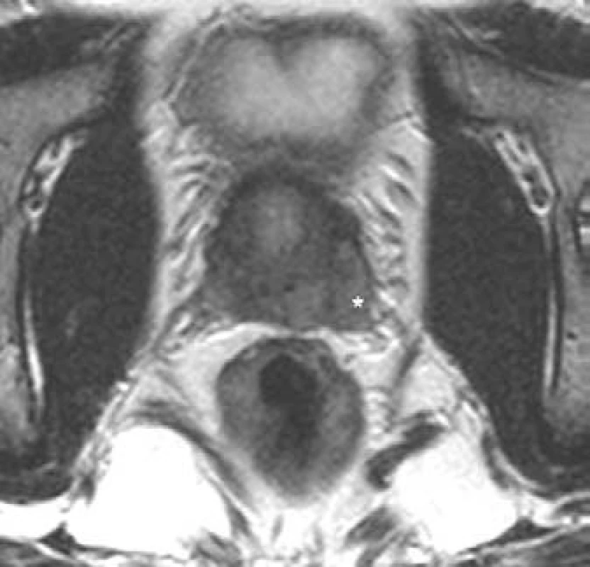 Karcinom prostaty s přerůstáním na oblast levého semenného váčku.