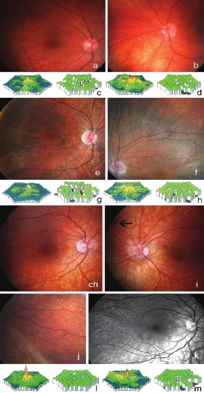 Klinické nálezy tří přenašeček retinitis pigmentosa. Fotografie fundu zobrazující prořídnutí retinálního pigmentového epitelu a zúžení retinálních arterií na pravém oku a), levém oku ženy III:1 b); celková foveolární alterace signálu a okrskové snížení funkce sítnice vpravo c) a vlevo d) zjištěné pomocí multifokální ERG u téže pacientky. Prořídnutí retinálního pigmentového epitelu, zúžení retinálních arterií a zrnitý vzhled sítnice ve střední periférii na pravém e) a levém oku u ženy III:5 f); změny při multifokální ERG vpravo g) a vlevo u téže pacientky h). Prořídnutí retinálního pigmentového epitelu a zúžení retinálních arterií na pravém oku u ženy IV:6 ch), podobný nález na levém oku a peripapilární atrofie v rámci těžké myopie a v nazálním horním kvadrantu shluk pigmentu ve tvaru hrudky (označen šipkou) i), zrnitý vzhled sítnice v dolním temporálním kvadrantu vpravo j); bezčervený snímek pravého oka k) a téměř normální nález při multifokální ERG vpravo l) a vlevo u téže ženy m)
