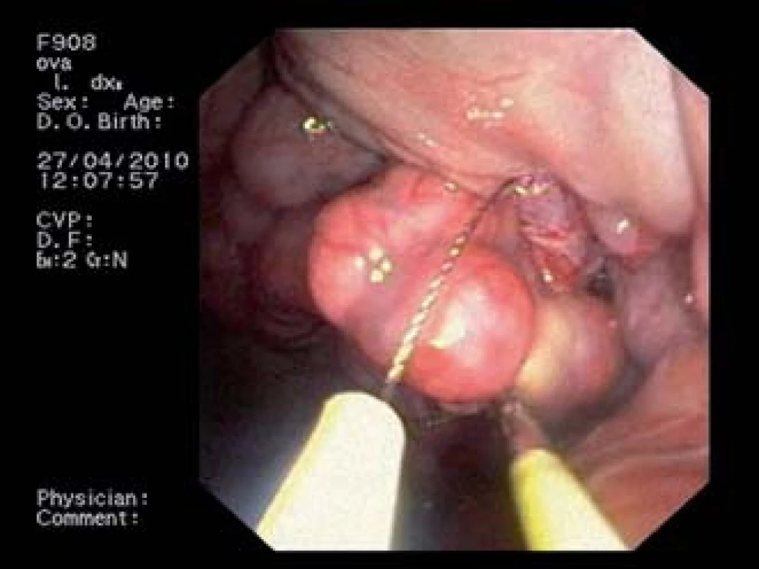 NOTES experimentální ovarektomie.
Fig. 6. NOTES experimental ovariectomy.