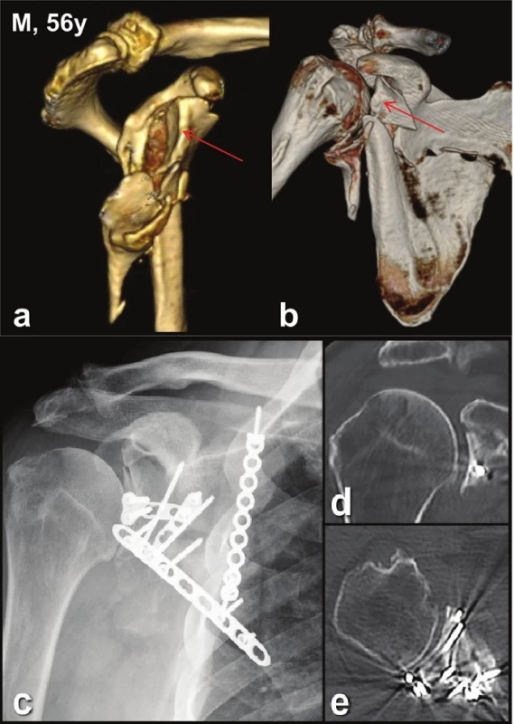 Glenoid fossa fractures (four fragments) with separation in the anatomical neck and fracture of infraspinous part of the scapular body (Pt − 3)