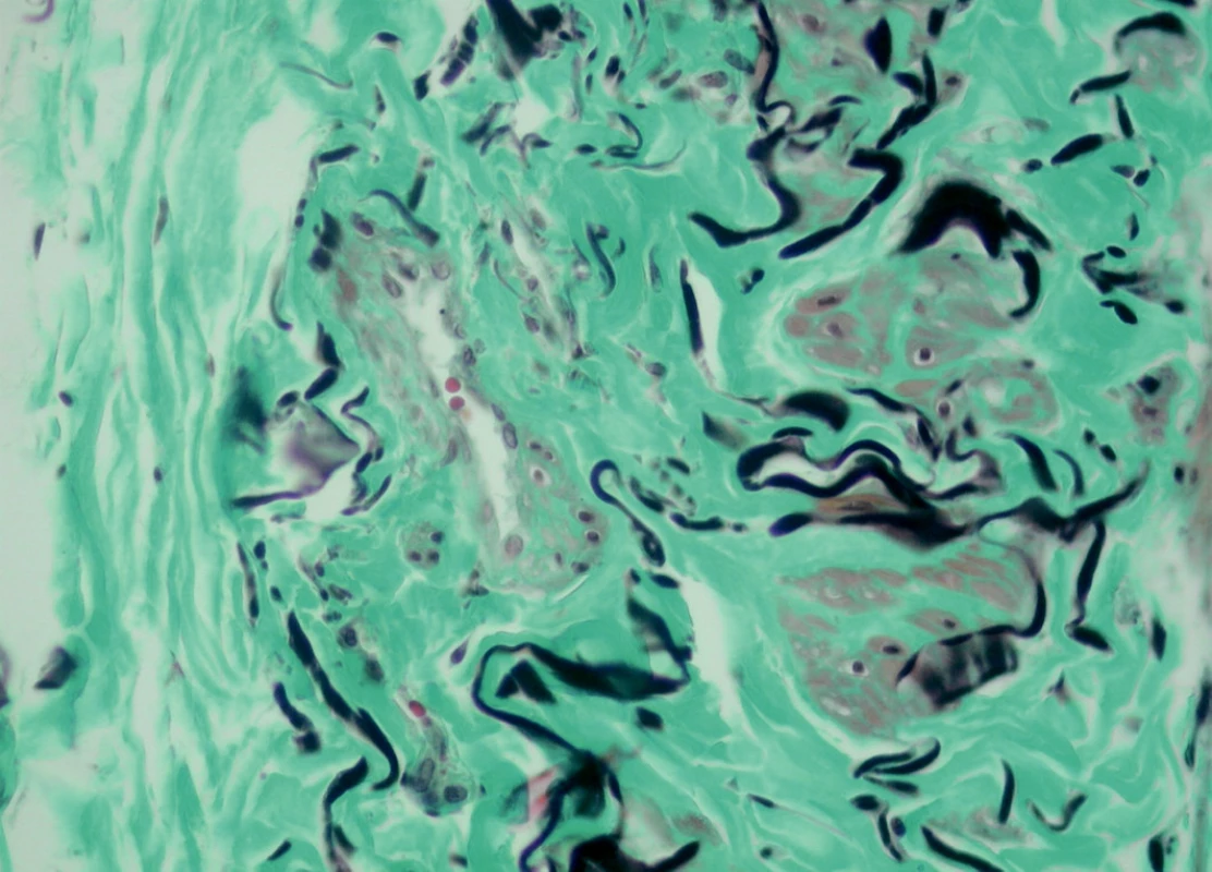 Tunica adventitia, M-TRI dle Kočové, zvětšení 40 x 10, s fragmentací elastických vláken a degenerovanými (metabolickými) typy buněk hladké svaloviny, které jsou obsaženy přímo ve stěně viditelné vasa vasorum.