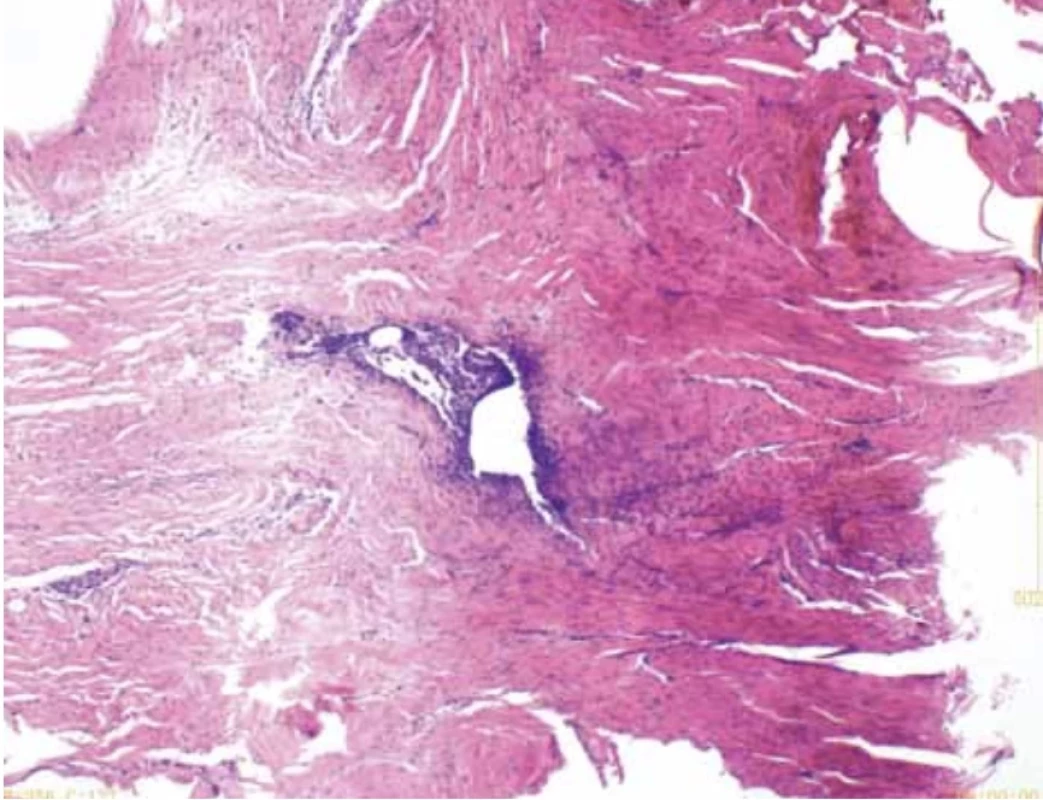 Histopathological image of the nodule. // Histopatologický obraz uzliny.