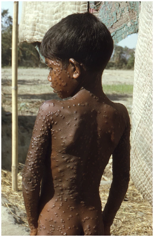 Smallpox is a uniquely human disease.