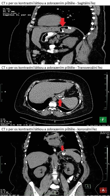 CT s per os kontrastní látkou zobrazující gastrolienální píštěl    Fig. 1: CT with oral contrast showing a gastrosplenic fistula